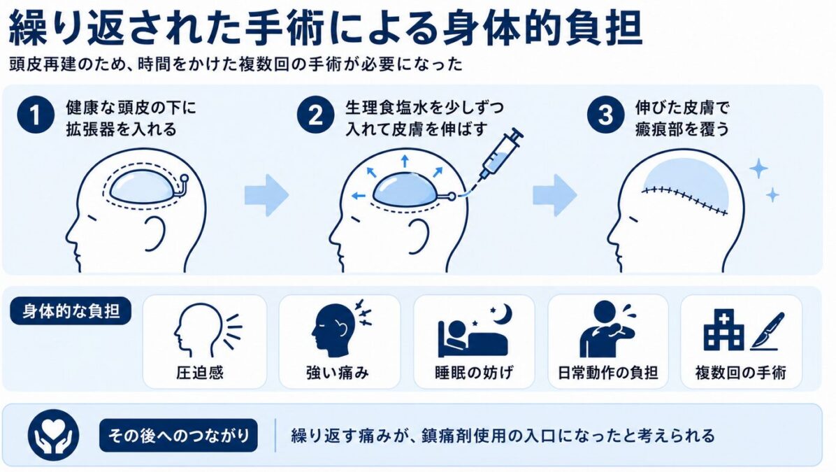 マイケルジャクソンのやけど　繰り返された手術による身体的負担